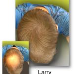 Before & After Larry